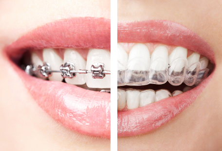 Clarity Ceramic Braces vs Invisalign - Andros Orthodontics, Tri Cities  Orthodontics