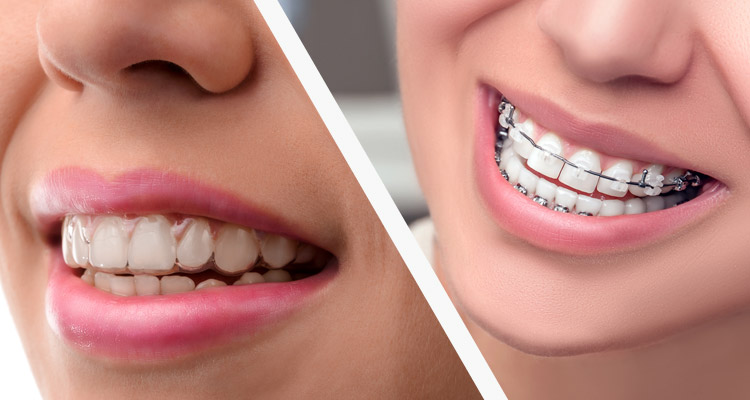 Trident Smiles Dental  Invisalign Aligners vs. Braces: Which is better for  your smile?