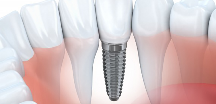 dental implants